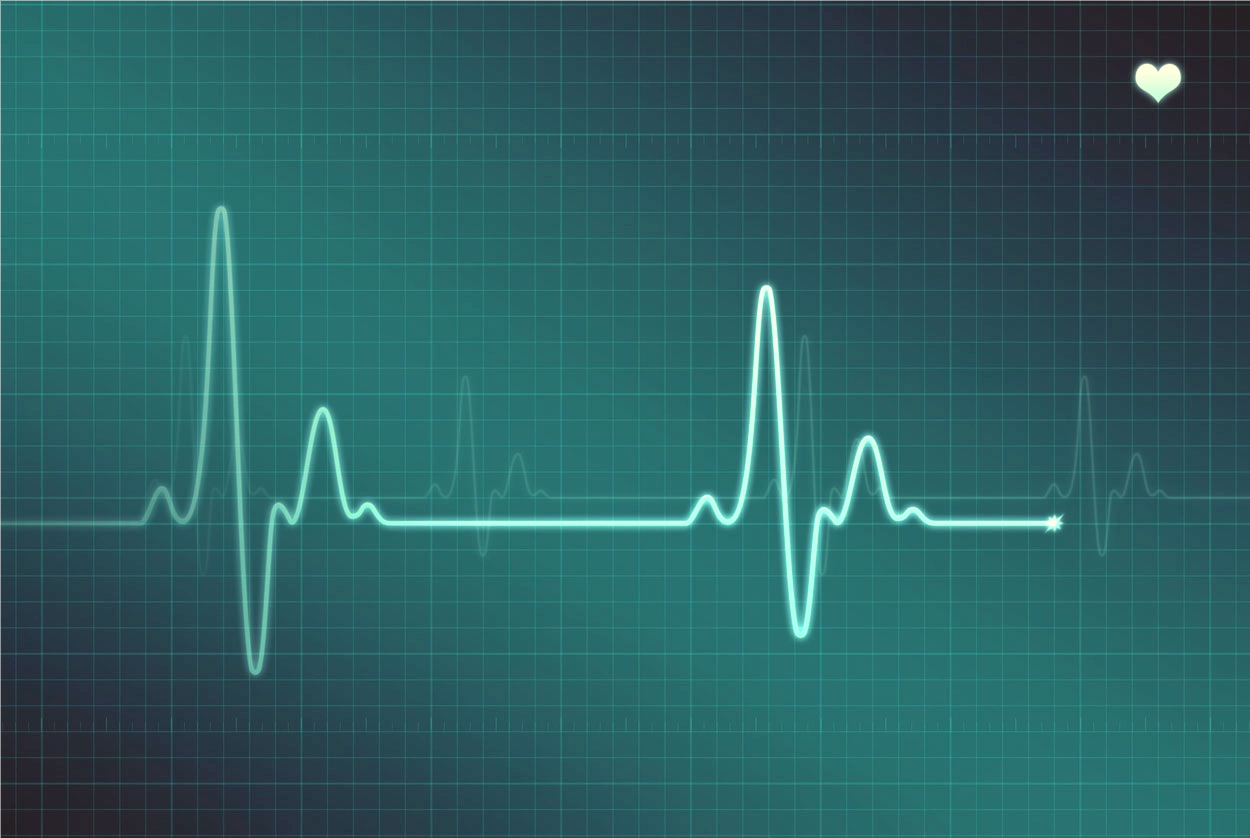 an ekg monitor showing an irregular heartbeat or arrythmia